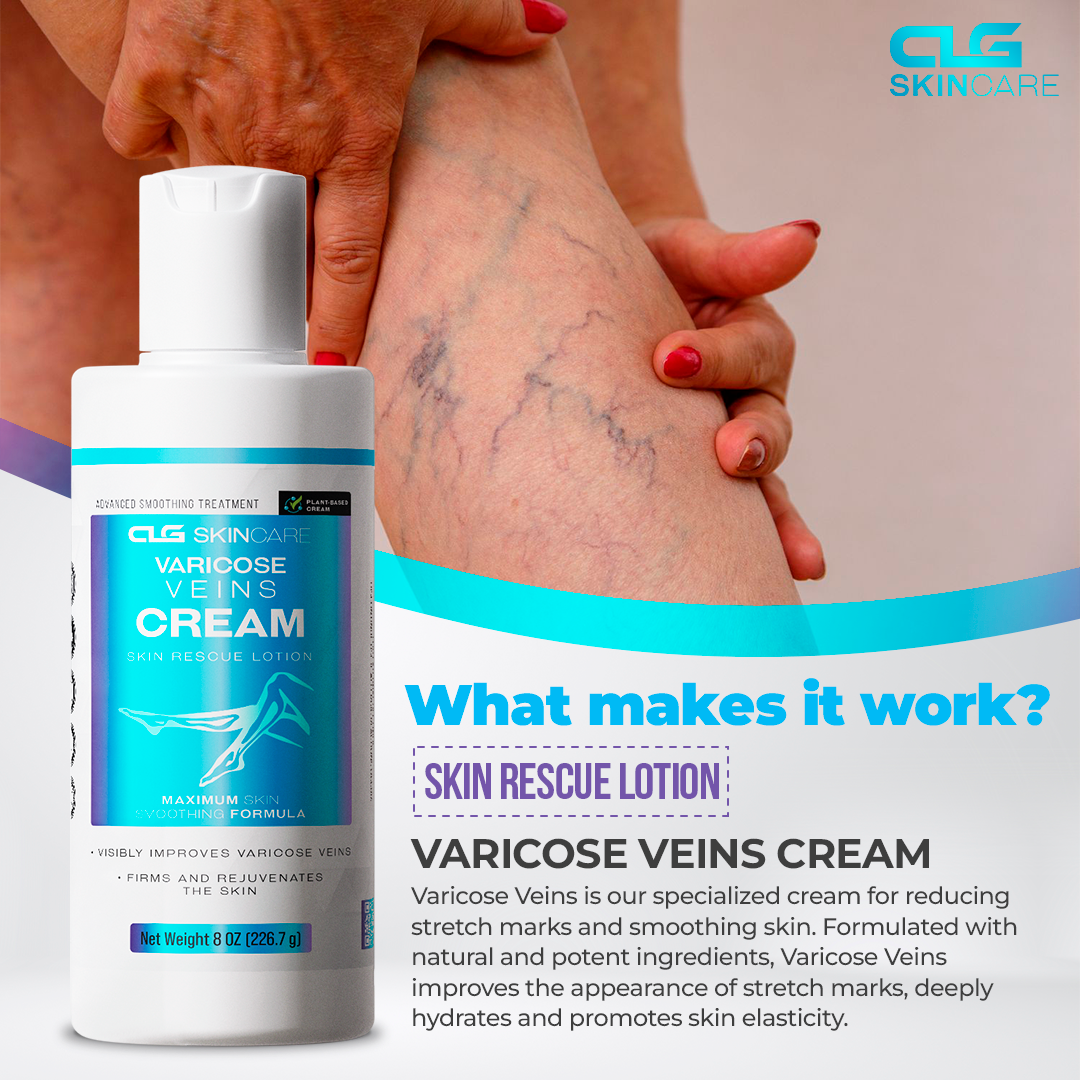 Varicose Veins Cream
