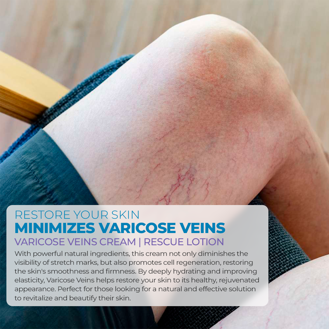 Varicose Veins Cream